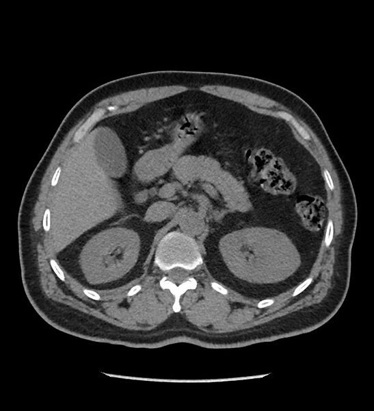 File:Chromophobe renal cell carcinoma (Radiopaedia 86879-103083 Axial non-contrast 25).jpg