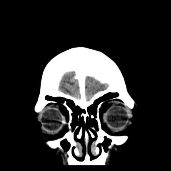 File:Chronic bilateral occipital lobe infarcts (Radiopaedia 31276-31996 Coronal non-contrast 7).jpg