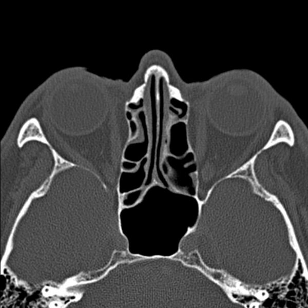 File:Chronic maxillary sinusitis (Radiopaedia 27879-28116 Axial bone window 33).jpg