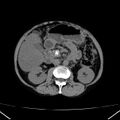 Chronic pancreatitis (Radiopaedia 23132-23172 Axial non-contrast 35).jpg
