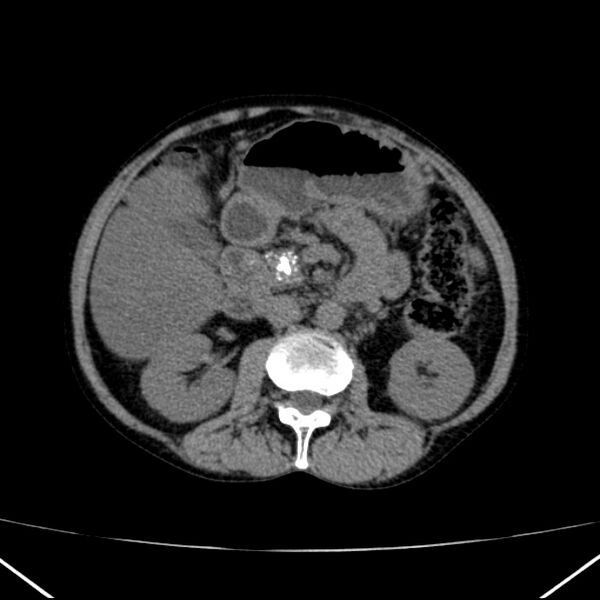 File:Chronic pancreatitis (Radiopaedia 23132-23172 Axial non-contrast 35).jpg