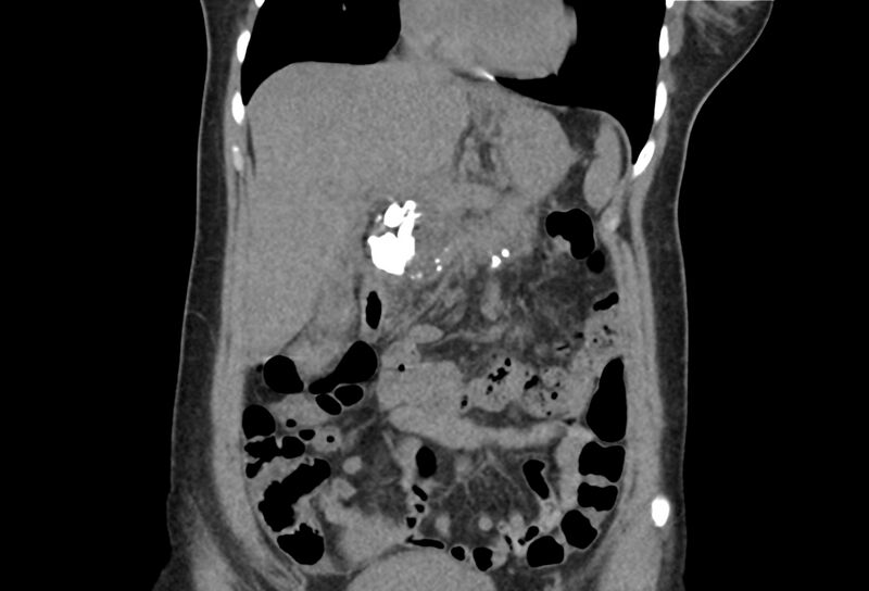 File:Chronic pancreatitis - pancreatic duct calculi (Radiopaedia 71818-82251 Coronal non-contrast 14).jpg