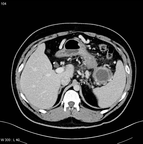 File:Chronic pancreatitis and pseudocysts (Radiopaedia 6724-7935 D 3).jpg