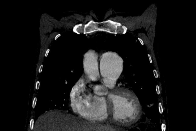 File:Chronic pulmonary embolism with bubbly consolidation (Radiopaedia 91248-108850 B 39).jpg