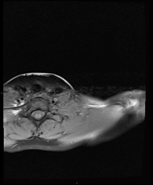 File:Chronic reactive multifocal osteomyelitis (CRMO) - clavicle (Radiopaedia 56406-63114 Axial T1 fat sat 6).jpg