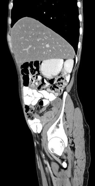 File:Chronic small bowel volvulus (Radiopaedia 75224-86322 C 113).jpg