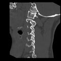 Clay-shoveler fracture (Radiopaedia 22568-22590 Sagittal bone window 8).jpg