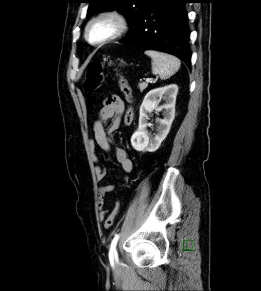 File:Clear cell renal cell carcinoma (Radiopaedia 85006-100539 E 15).jpg