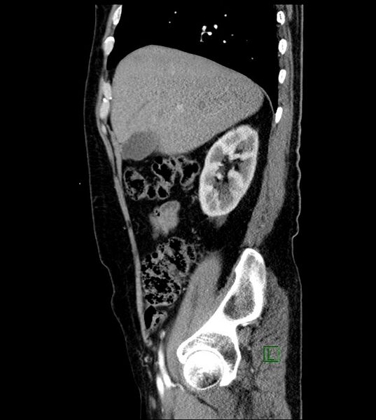 File:Clear cell renal cell carcinoma (Radiopaedia 85006-100539 E 45).jpg