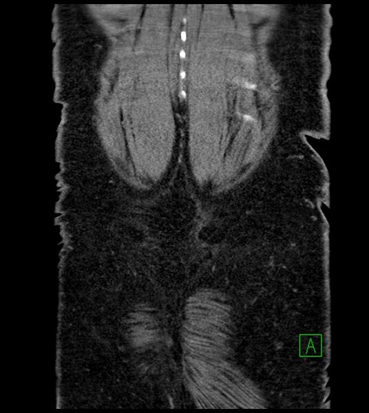 File:Closed-loop small bowel obstruction-internal hernia (Radiopaedia 78439-91096 Coronal non-contrast 95).jpg