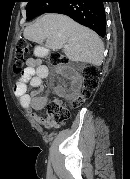 File:Closed loop obstruction - internal hernia into nephrectomy bed (Radiopaedia 59867-67320 C 78).jpg