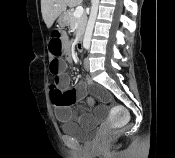 File:Closed loop small bowel obstruction (Radiopaedia 71211-81508 C 75).jpg