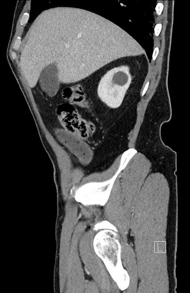 File:Closed loop small bowel obstruction - internal hernia (Radiopaedia 57806-64778 C 89).jpg