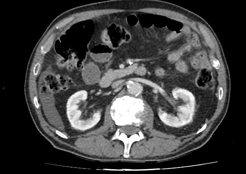 File:Closed loop small bowel obstruction with ischemia (Radiopaedia 84180-99456 A 47).jpg