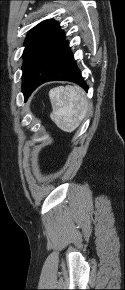 File:Coarctation of the aorta (Radiopaedia 74632-88521 C 291).jpg