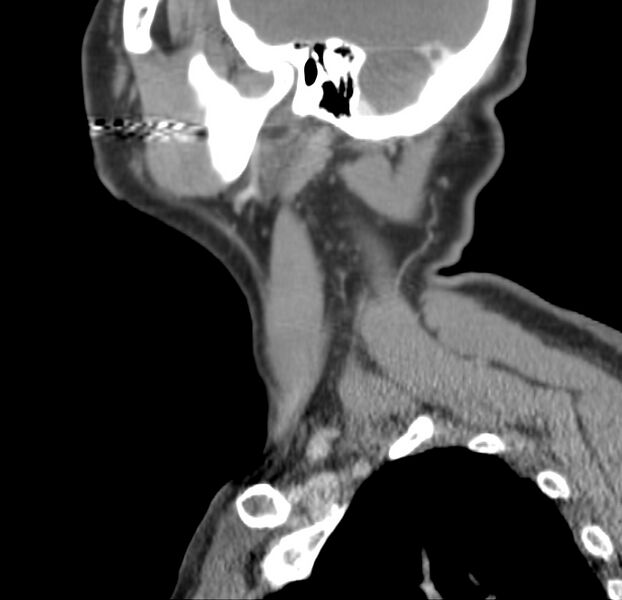File:Colloid cyst of thyroid (Radiopaedia 22897-22923 Sagittal C+ delayed 47).jpg