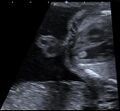 Fetal cardiac rhabdomyoma (Radiopaedia 37043).jpg