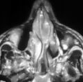 Nasal septum hematoma (Radiopaedia 6778-7968 D 1).jpg