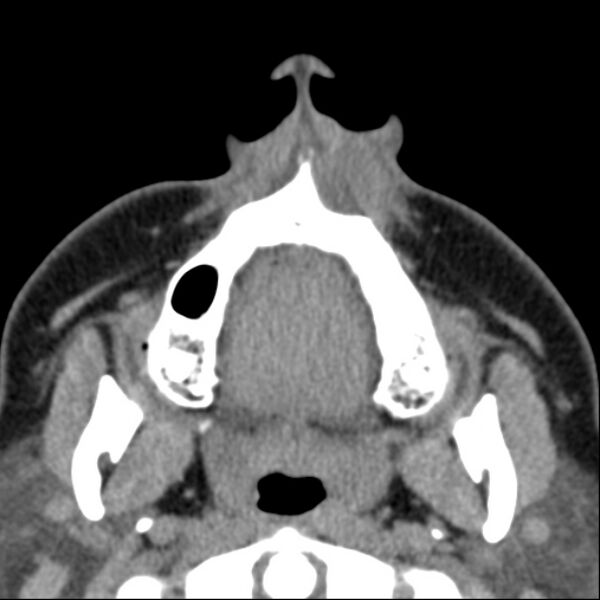 File:Nasolabial cyst (Radiopaedia 33987-35205 Axial non-contrast 5).jpg