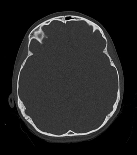 File:Nasoorbitoethmoid fracture (Radiopaedia 90044-107205 Axial bone window 95).jpg