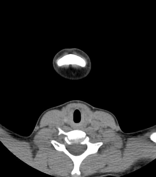 File:Nasoorbitoethmoid fracture (Radiopaedia 90044-107205 Axial non-contrast 14).jpg