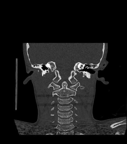 File:Nasoorbitoethmoid fracture (Radiopaedia 90044-107205 Coronal bone window 102).jpg