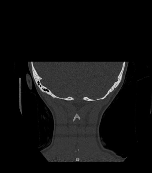 File:Nasoorbitoethmoid fracture (Radiopaedia 90044-107205 Coronal bone window 132).jpg