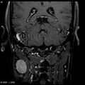 Nasopharyngeal carcinoma (Radiopaedia 4546-6667 E 20).jpg