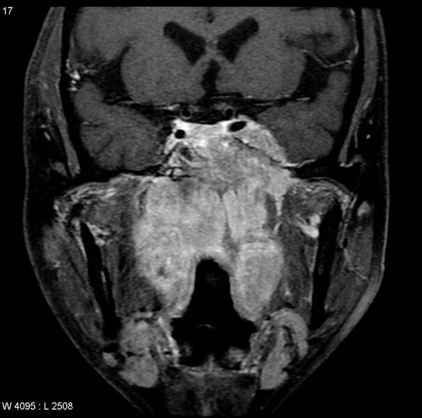 File:Nasopharyngeal carcinoma (Radiopaedia 4546-6667 E 7).jpg
