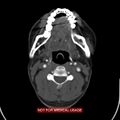 Nasopharyngeal carcinoma recurrence - skull base destruction (Radiopaedia 29107-29491 A 20).jpg