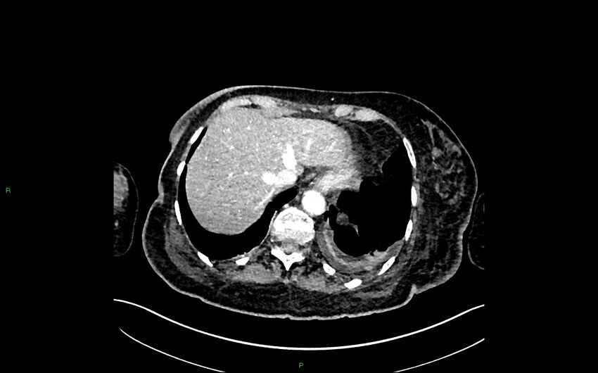 Neo-terminal ileal stricture (Crohn disease) (Radiopaedia 33790-34948 A 53).jpg