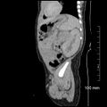 Neonatal neuroblastoma (Radiopaedia 56651-63438 C 28).jpg