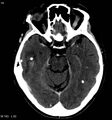 Neurocysticercosis (Radiopaedia 7773-8596 C+ delayed 2).jpg