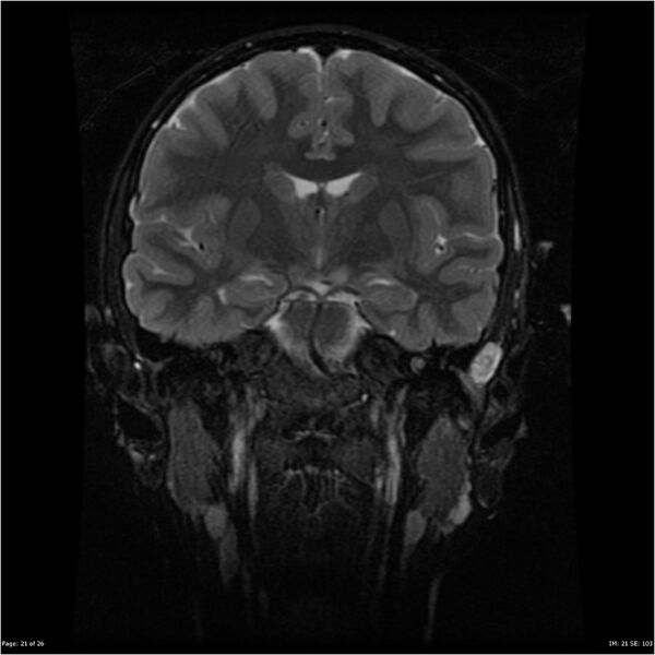 File:Neurofibromatosis type 1 (Radiopaedia 22541-22564 Coronal T2 fat sat 12).jpg