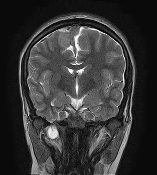 File:Neurofibromatosis type 2 (Radiopaedia 66211-75401 Coronal T2 11).jpg