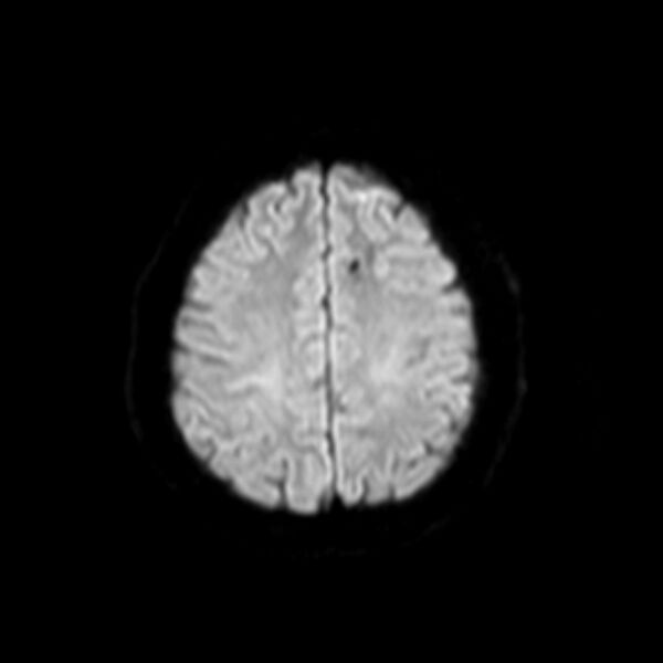 File:Neurofibromatosis type 2 (Radiopaedia 67470-76871 Axial DWI 16).jpg