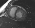 Non-compaction of the left ventricle (Radiopaedia 69436-79314 Short axis cine 129).jpg