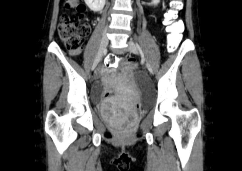 File:Non-puerperal uterine inversion (Radiopaedia 78343-91094 B 7).jpg