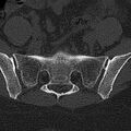 Normal CT lumbar spine (Radiopaedia 53981-60118 Axial bone window 71).jpg