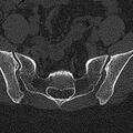 Normal CT lumbar spine (Radiopaedia 53981-60118 Axial bone window 74).jpg