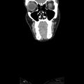 Normal CT of the neck (Radiopaedia 14575-14500 Coronal C+ 8).jpg