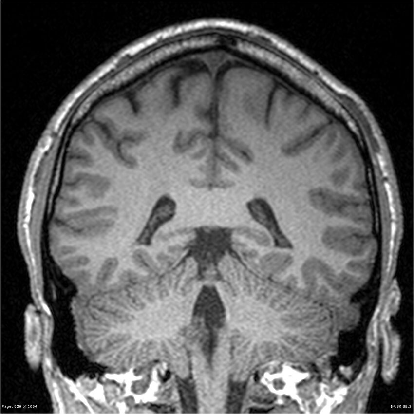 Normal brain MRI (non-focal epilepsy protocol) (Radiopaedia 38571-40700 Coronal T1 39).jpg