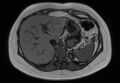 Normal liver MRI with Gadolinium (Radiopaedia 58913-66163 B 23).jpg