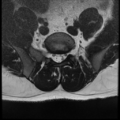 Normal lumbar spine MRI (Radiopaedia 35543-37039 Axial T2 7).png