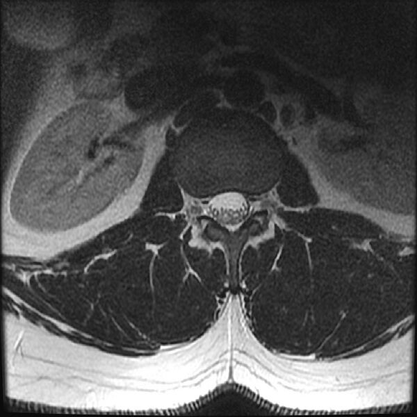 File:Normal lumbar spine MRI (Radiopaedia 43051-46311 Axial T2 2).jpg