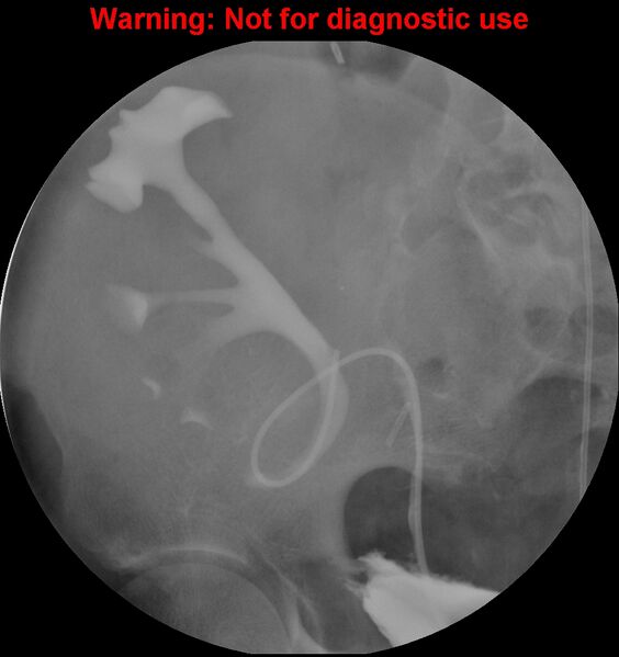 File:Normal retrograde pyelography of a native and transplant kidney (Radiopaedia 40480-43054 Transplant kidney 22).jpg