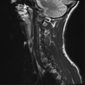 Normal trauma cervical spine (Radiopaedia 41017-43762 Sagittal T2 3).png