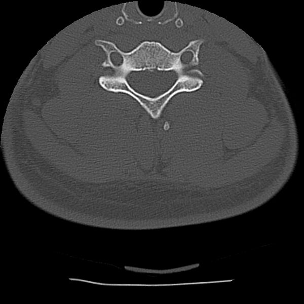 File:Normal trauma spine imaging (Radiopaedia 31753-32686 Axial bone window 57).jpg