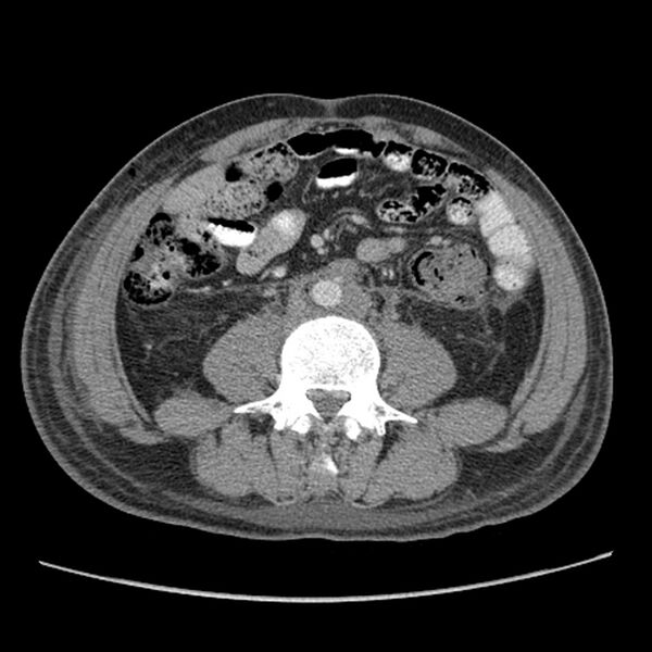 File:Obstructive bladder transitional cell carcinoma (Radiopaedia 9825-10410 A 15).jpg
