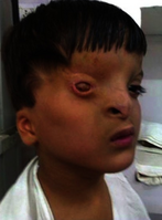 Cryptophthalmos, left eye ptosis, triangular face, low-set ears